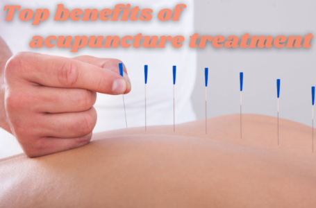 Top Benefits of Acupuncture Treatment