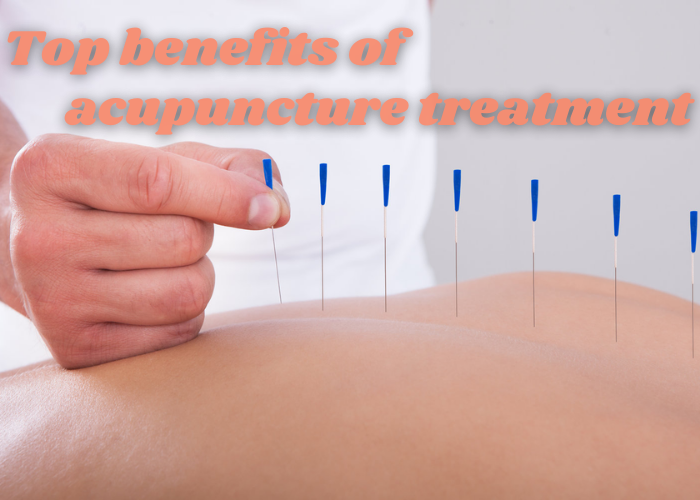 Top benefits of acupuncture treatment