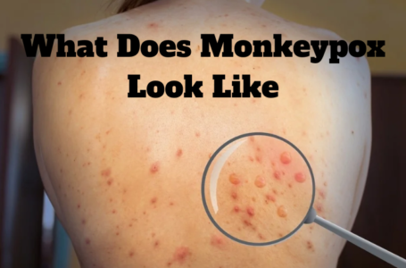 What Does Monkeypox Look Like