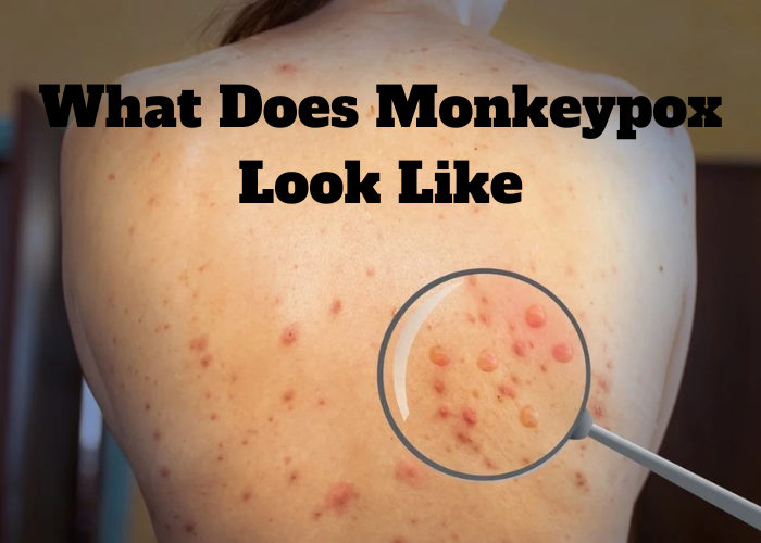 What does monkeypox look like
